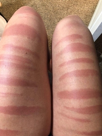 My cousins legs after a day in the sun in ripped jeans