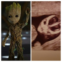 My first born about to come out looking like baby Groot