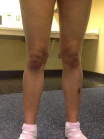 My friends knees look like Hitler