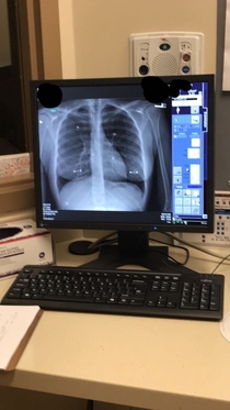 My girlfriend got an X-ray today and forgot to tell the doctor she had her nipples pierced