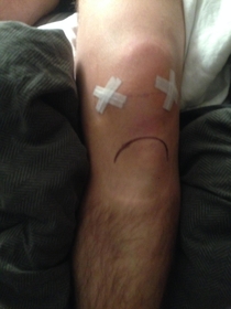 My girlfriend thought my knee looked pretty sad after surgery 