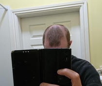 My receding hairline looks like I have a reddit upvote on my head