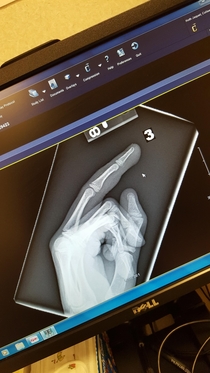 My  yr old daughter shut her middle finger in the car door its not broken but the x-ray will live in infamy