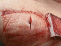One photograph per day of a healing wound