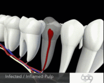 Root Canal Animation 