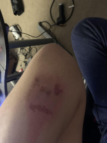 So I recently lightly burned my elbow and my elbow doesnt look too happy about it