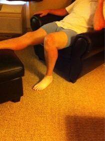 So my mom sends me a text This is your dads golfing sunburn hes not wearing socks