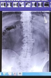 Texted my wife this x-ray of my spinehoping for sympathy She responded with Body like a back road lol  for sensitivity