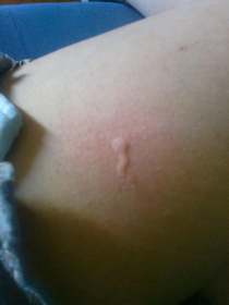 That time I had a sperm-shaped mosquito bite