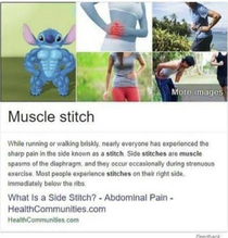 Thats indeed a muscle stitch