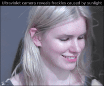 Ultraviolet camera reveals freckles caused by sunlight