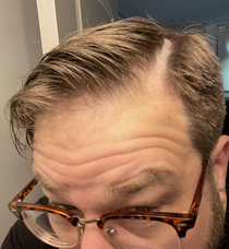 Went to a new barber Asked for my part to be cut in SHE MOWED A FUCKING  STRIPE OUT OF MY HEAD
