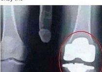 What a knee surgery