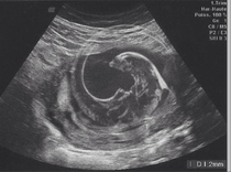 When my wife had an ultrasound for our first child I took a photo of the print out so she could send to friends and family on whats app Instead I sent her this xenomorph image and she sent it to everyone before realising what it was She was not amused