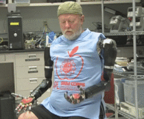 Worlds first bilateral shoulder level amputee controlling two prosthetic arms at once